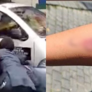 Penguatkuasa DBKL Cedera, Kena Gigit Penjaja Tak Ada Lesen