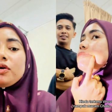 [VIDEO] Kieda Crepe Dijangkiti Virus Herpes – ‘Bibir Naik Biji & Kebas’